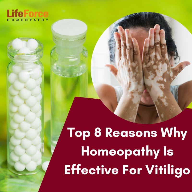 Top 8 Reasons Why Homeopathy Is Effective For Vitiligo