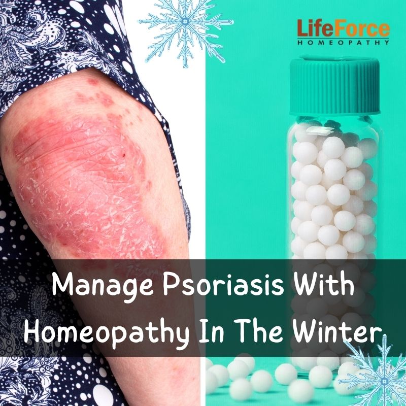 Manage Psoriasis With Homeopathy In The Winter