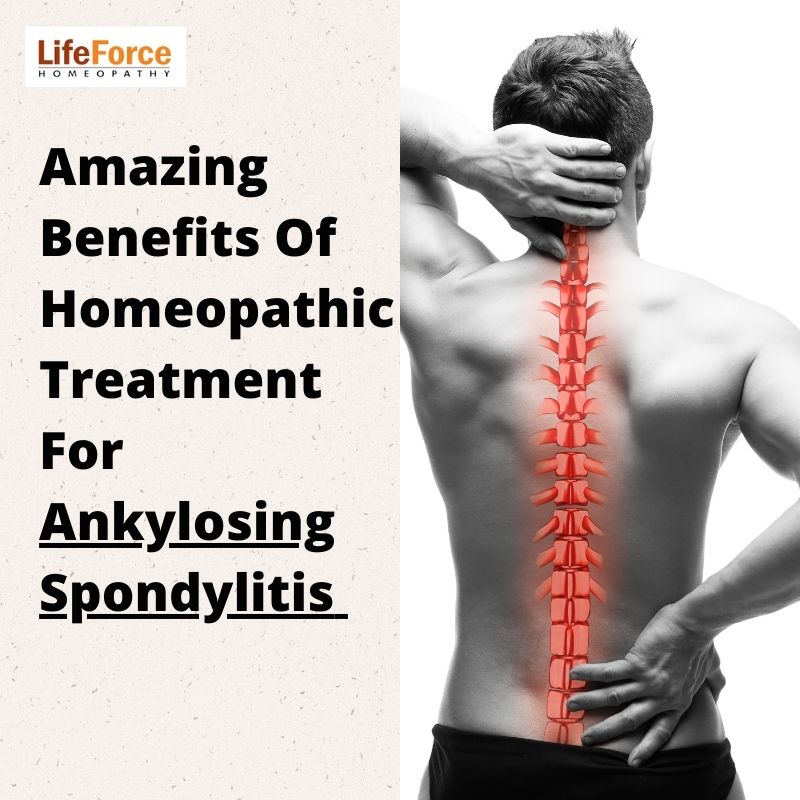 Treatment For Ankylosing Spondylitis
