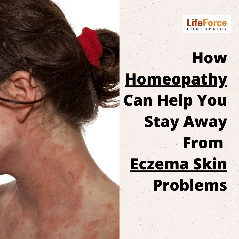 homeopathic treatment for eczema.
