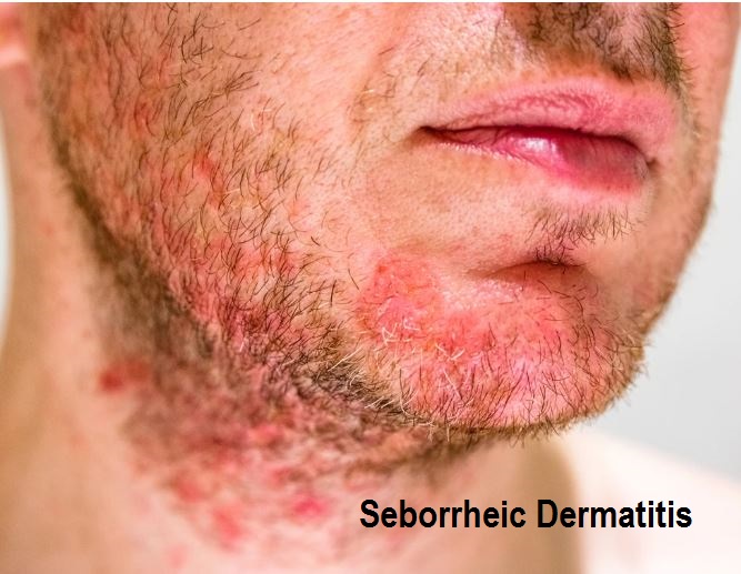 Learn About Seborrheic Dermatitis And Its Homeopathic Remedies