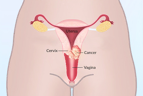 Are you at risk of Cervical Cancer?