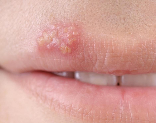 Is it a Cold Sore or a Pimple?