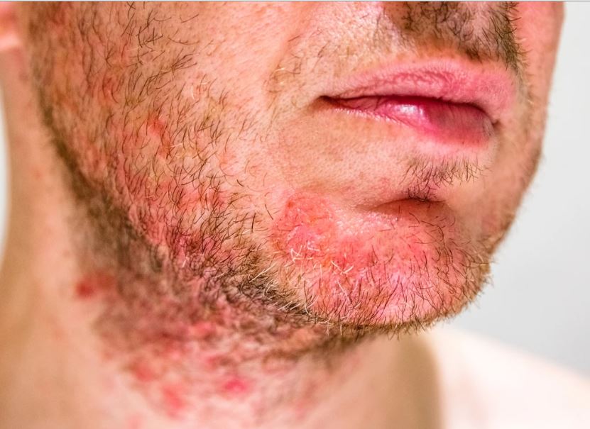 All About Seborrheic Dermatitis That You Should Know