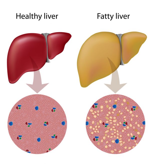 How To Deal With Grade 1 Fatty Liver?