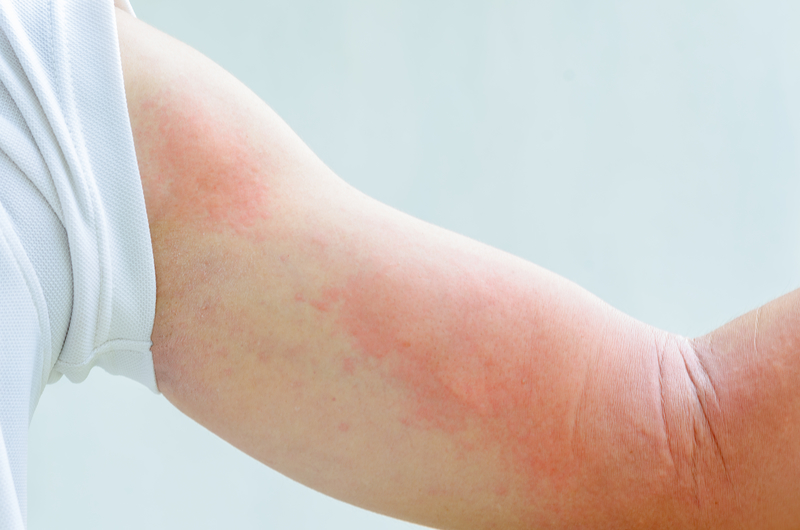 Everything You Need To Know About Acute Urticaria