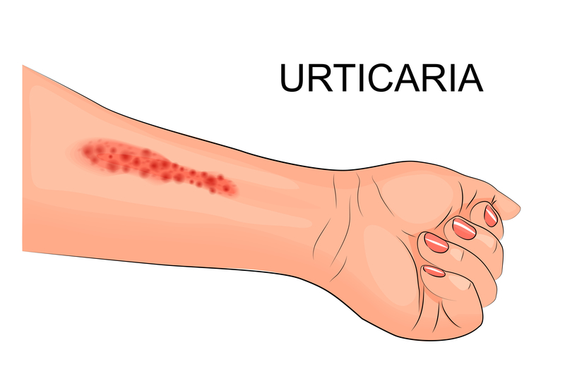 urticaria treatment