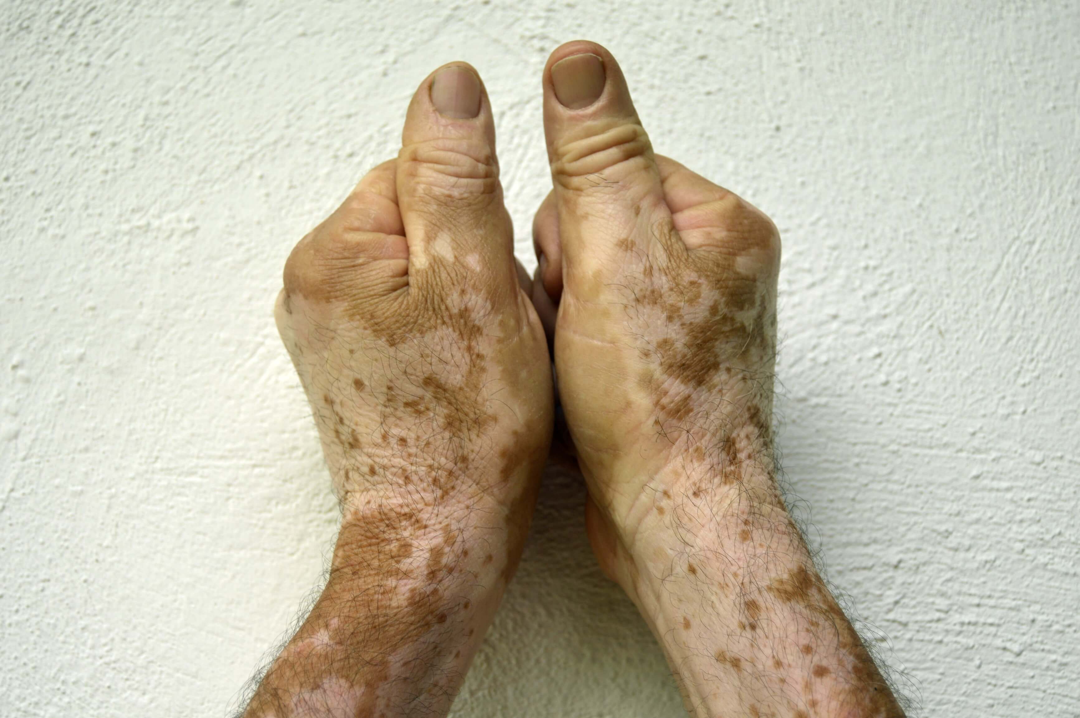 What will increase your threat of creating vitiligo? What will increase your threat of creating vitiligo?