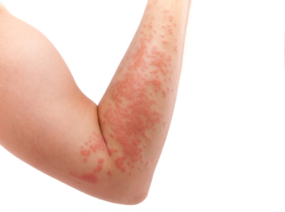 Tired of Eczema? Homeopathic Treatment Will Help You to Cure it