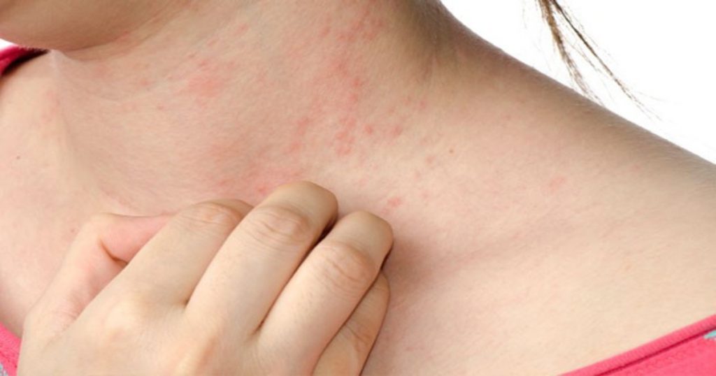Ichy rash of eczema