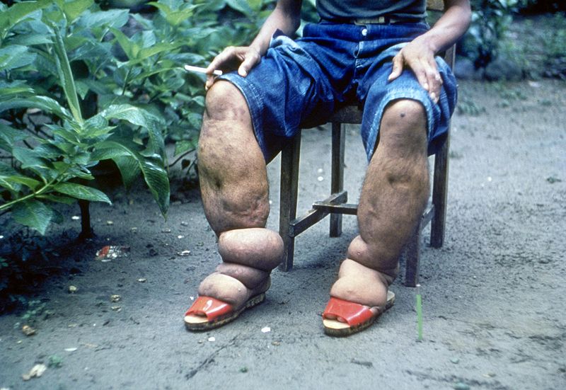 Learn All About Elephantiasis & Its Treatment With The Help Of Homeopathy