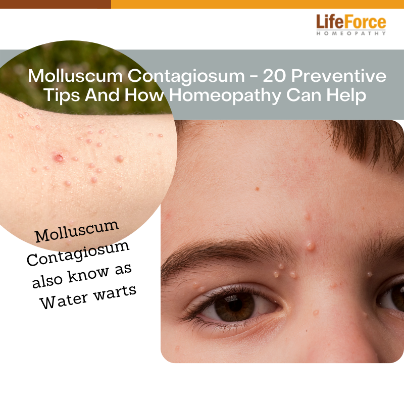 Molluscum Contagiosum – 20 Preventive Tips And How Homeopathy Can Help