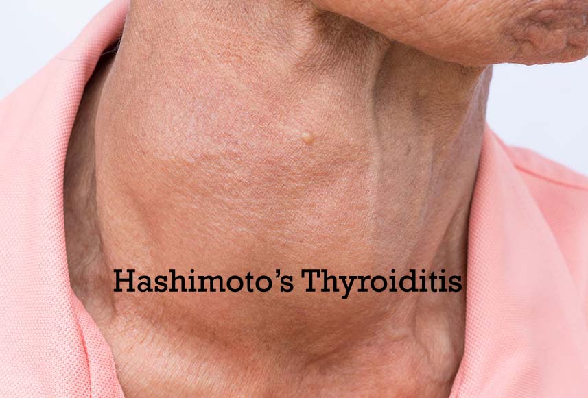 All You Need To Know About Hashimoto’s Thyroiditis