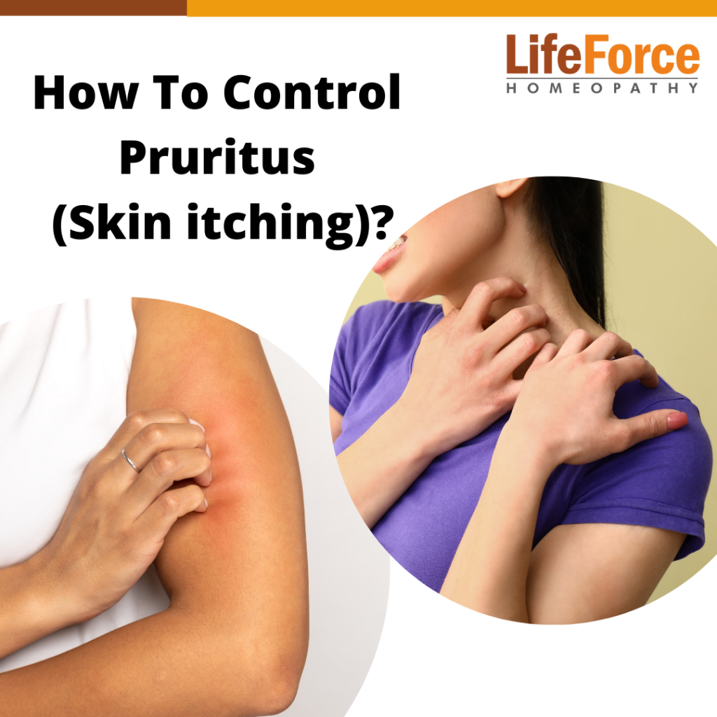 How To Control Pruritus (Skin itching)?