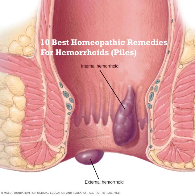 10 Best Homeopathic Remedies For Hemorrhoids (Piles)
