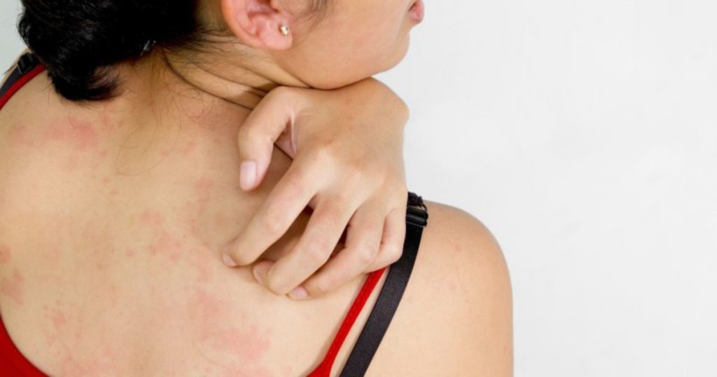 Are Hives (Urticaria) Contagious?