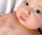 Chronic hives in children & its treatment