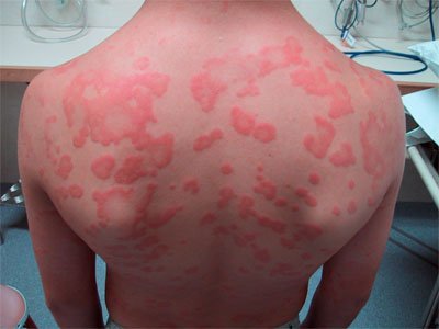 Everything One Must Be Aware Of Urticaria Or Hives