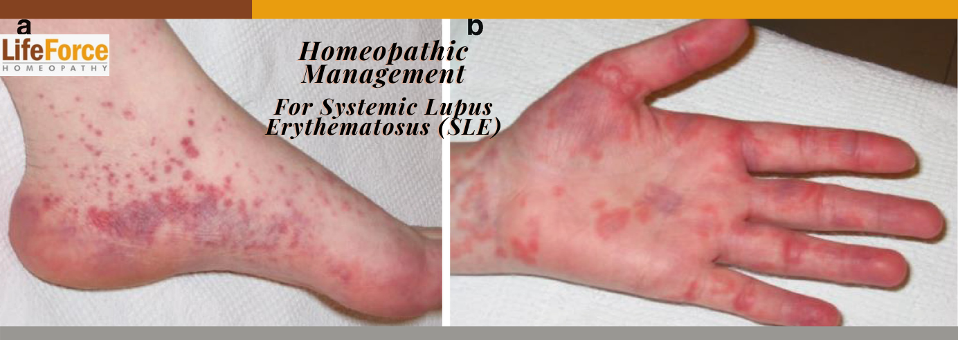 What Is Systemic Lupus Erythematosus Sle Quizlet