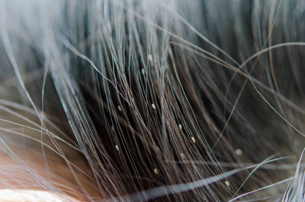 How To Get Rid Of Nits And Lice In Hair?