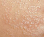 Could Your Tiny Skin Bumps Be Lichen Nitidus – An Unusual Skin Condition?
