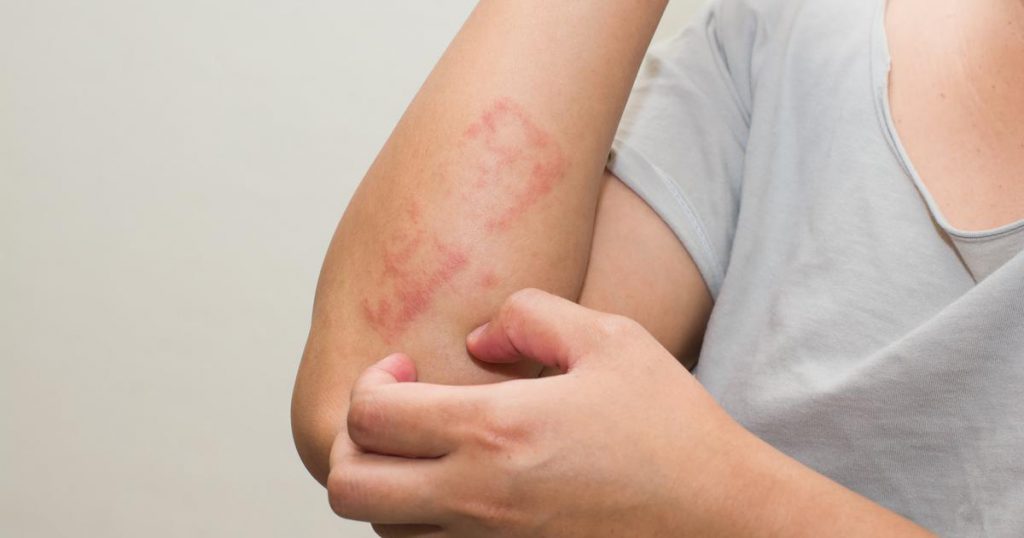 The Causes, Symptoms and Cure for Lichen Planus