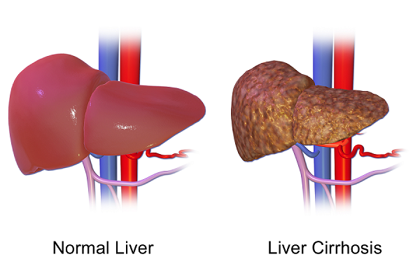 Difference between a normal liver and a fatty liver