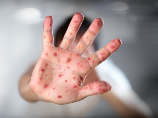 Top 5 Homeopathic Remedies For Measles