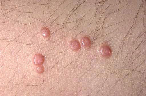 Is your Child at Risk for Molluscum contagiosum?