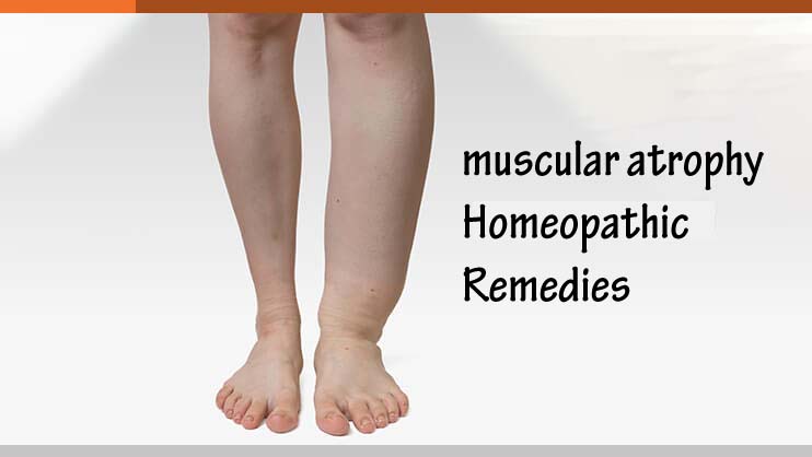 Know About Muscular Atrophy And Its Homeopathic Remedies