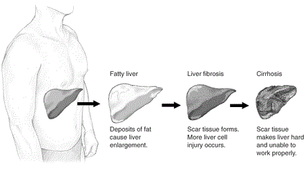 Different stages of fatty liver as damage increases.