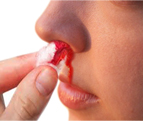 Primary treatment for epistaxis (nosebleed)