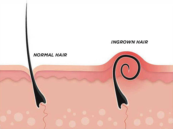 Ingrown Hair  Know How To Deal With It