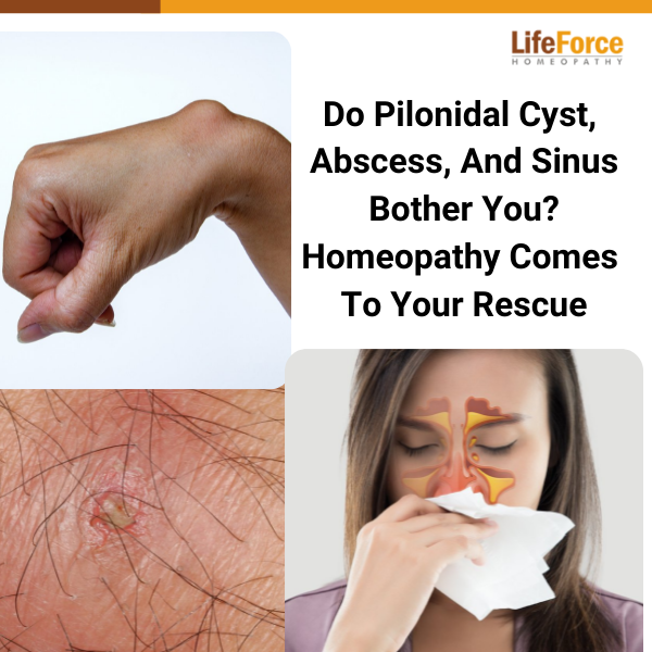 Pilonidal Cyst, Abscess, And Sinus Bother You