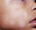 Pityriasis Alba – Not all white spots are Vitiligo