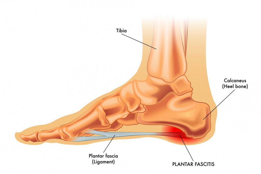 Ease Plantar Fasciitis Pain With Homeopathy