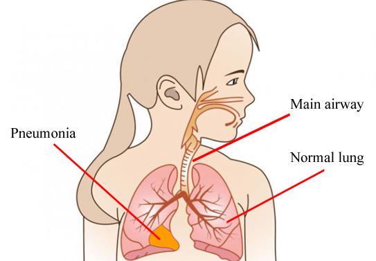 Pneumonia: The Most Common Childhood Illness In Winter