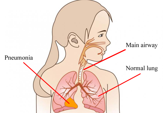 Hasil carian imej untuk ‪pneumonia‬‏