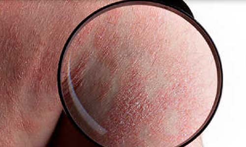 Dos & Don’ts For The Best Psoriasis Treatment