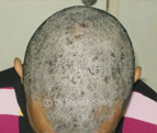 Scalp Psoriasis – A Smarter and Effective way to Care and Cure