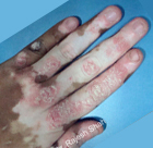 Vitiligo mixed with Lichen Planus, Eczema and Psoriasis