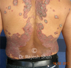 Can psoriasis be treated without using Methotrexate (immunosuppressant)?
