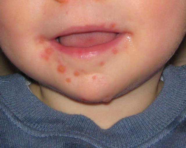 Homeopathy For Scabies In Infants