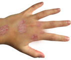 Skin care tips for Psoriasis