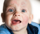 5 Common skin infections in infants