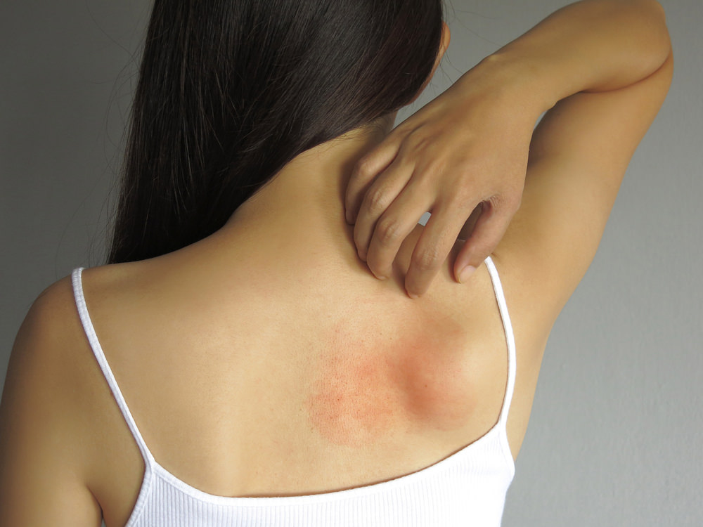 Can Your Simple Skin Rash Be Atopic Dermatitis? It Is Just A Click Away!