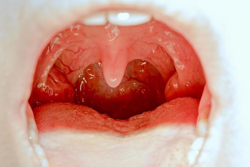 Is Tonsillitis Contagious?