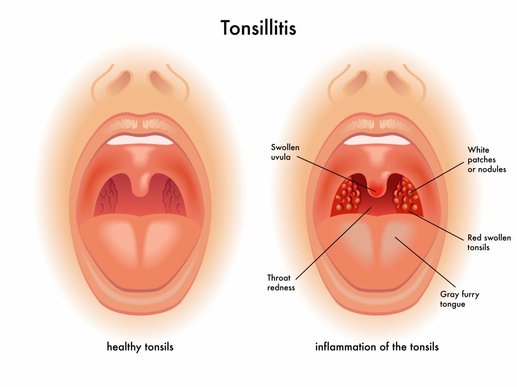 10 Simple Yet Incredible Home Remedies For Tonsillitis