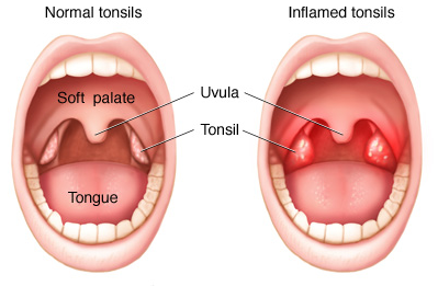 Homeopathy For Recurrent Tonsillitis