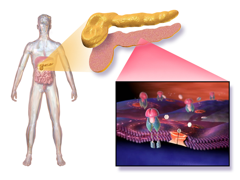 Inability of pancreas to produce enough insulin